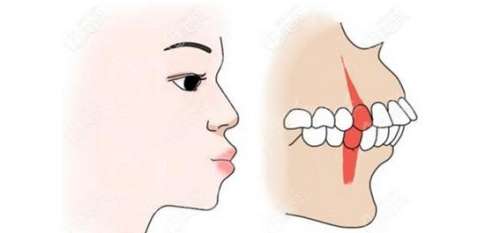 齙牙好矯正嗎？了解齙牙矯正的效果和方法！