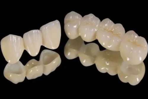 純鈦合金烤瓷牙：美麗牙齒的佳選擇