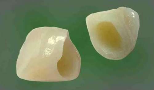 不僅烤瓷牙，還有哪些方法能夠遮暇牙齒？