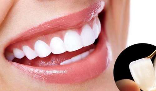 瓷貼面的好處和壞處全解析，了解一下吧！