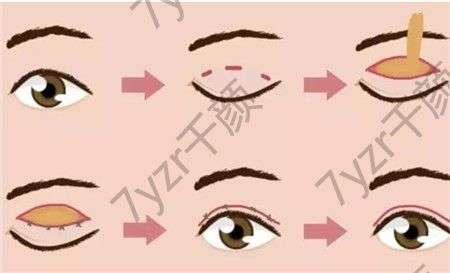 全切雙眼皮的優(yōu)點(diǎn)和缺點(diǎn)是什么