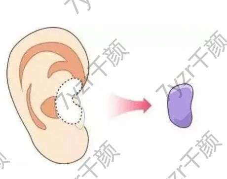 耳軟骨墊鼻尖有什么優(yōu)點，注意事項有哪些