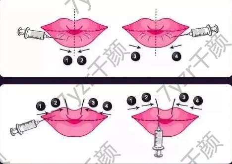 豐唇的價格一般是多少，軟化需要多長時間