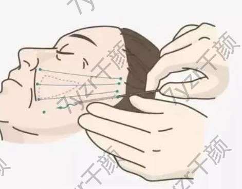 電波拉皮的作用是什么