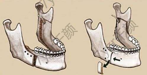 正頜手術(shù)大概多少錢(qián)？手術(shù)費(fèi)用及恢復(fù)時(shí)間詳解