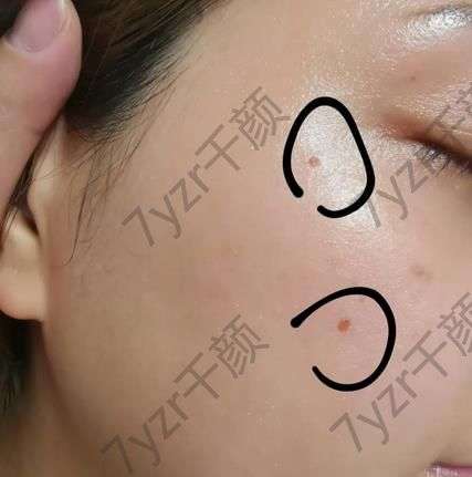 激光點(diǎn)痣后恢復(fù)過(guò)程？激光點(diǎn)痣后注意事項(xiàng)盤(pán)點(diǎn)