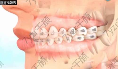 衡陽牙齒矯正價格多少錢？牙齒矯正需要注意的事項盤點
