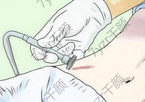 手術(shù)疤痕如何去除？