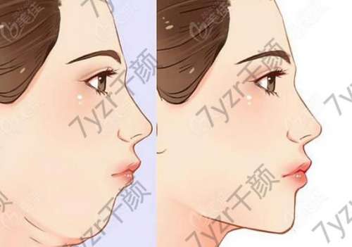 雙下巴抽脂手術(shù)大概花多少錢？價格區(qū)間介紹，醫(yī)院、風(fēng)險詳細(xì)了解