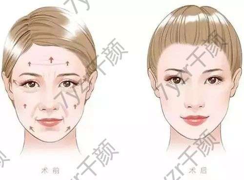 脂肪填充多了怎么辦？脂肪填充恢復(fù)時間大講解