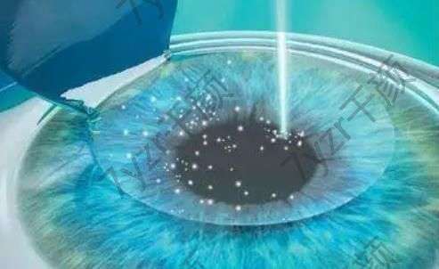 半飛秒和全飛秒?yún)^(qū)別利弊，近視手術(shù)半飛秒和全飛秒?yún)^(qū)別