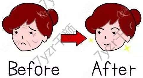 黃廣香拉皮案例分享，醫(yī)生資料簡介、價(jià)格、口碑測評